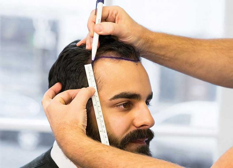 ترمیم مو به روش فرنچ لس