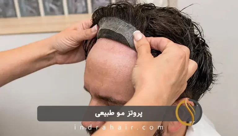 پروتز مو