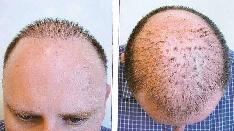 مزایای کاشت مو برای موهای کم پشت