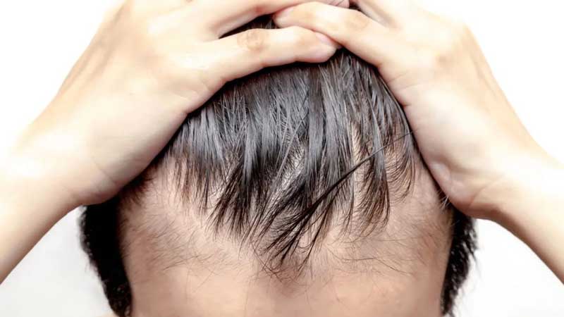 درمان ریزش موی شدید