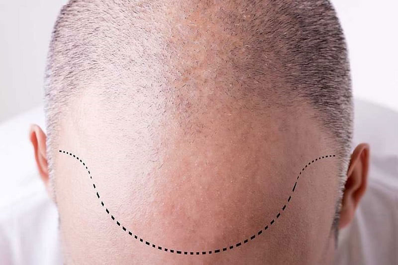 اصلاح طراحی خط رویش با کاشت مو