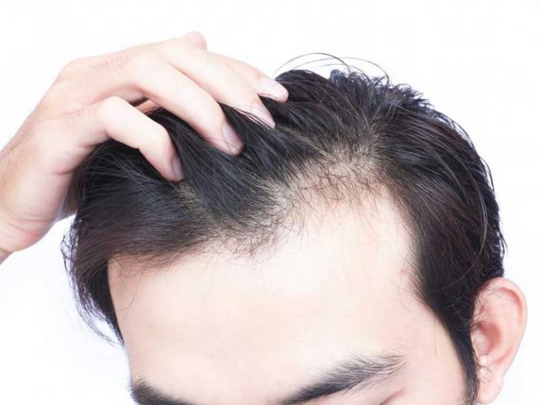 میکرو اسکالپ شقیقه چیست؟