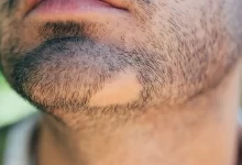 درمان ریزش ریش در مردان