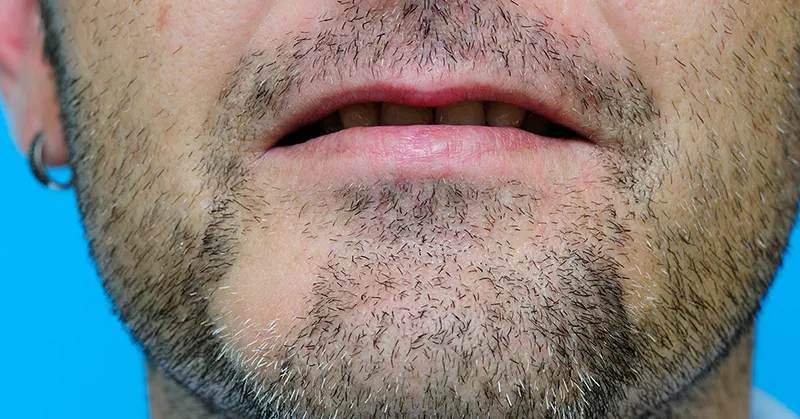 درمان ریزش ریش در مردان