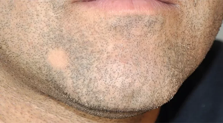 ریزش ریش سکه ای