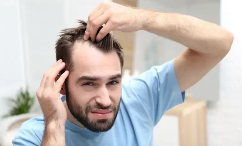 درمان ریزش موی مردان