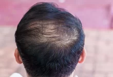 درمان سریع ریزش مو