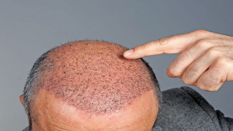 کاشت مو برای بیماران دیابتی