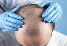 کاشت مو برای بیماران دیابتی