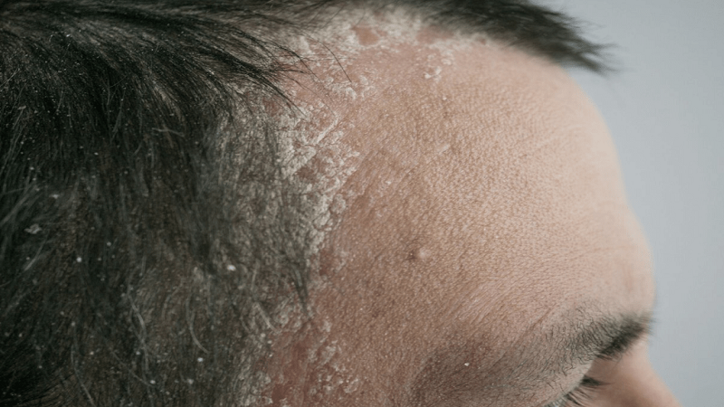 کاشت مو برای بیماران پسوریازیس