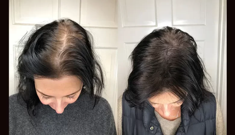 اسکالپ سر برای چه کسانی مناسب است؟