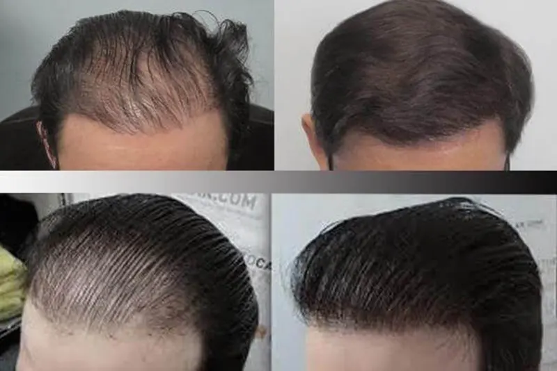 کاشت موی مصنوعی مردانه در تهران