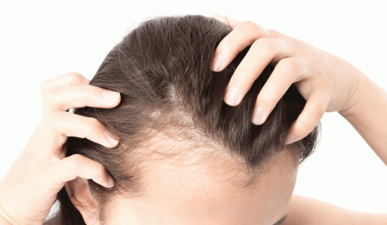 کاشت مو برای شقیقه سر