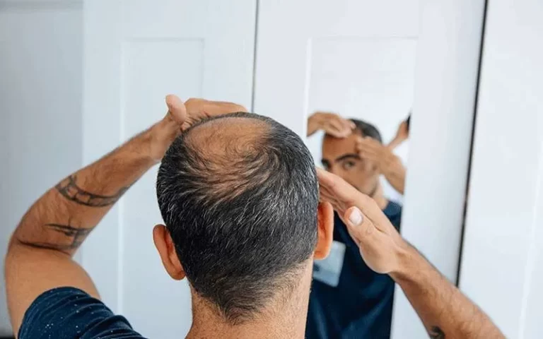 ماینوکسیدیل خارجی بهتره یا ایرانی؟