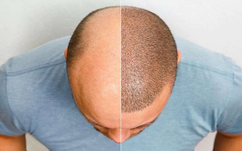 آیا کاشت مو خطر دارد