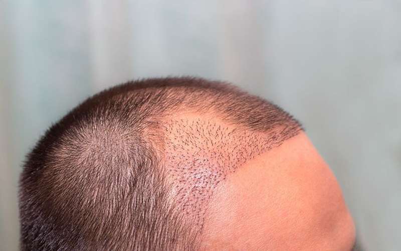 کاشت مو چیست؟