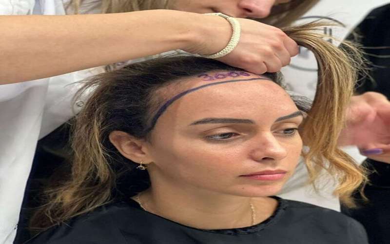 هزینه کاشت مو چقدر است؟