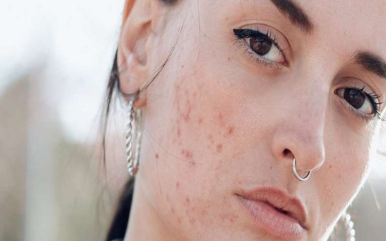 از بین بردن جوش صورت در یک روز