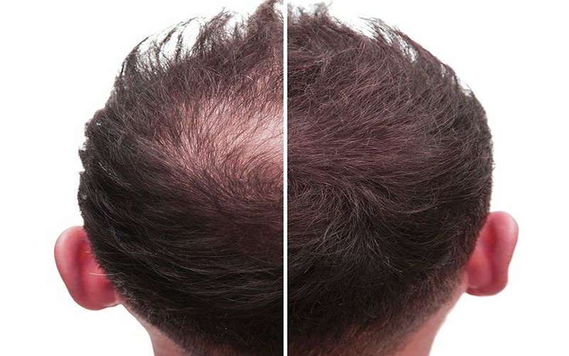 از ریزش مو چگونه جلوگیری کنیم؟