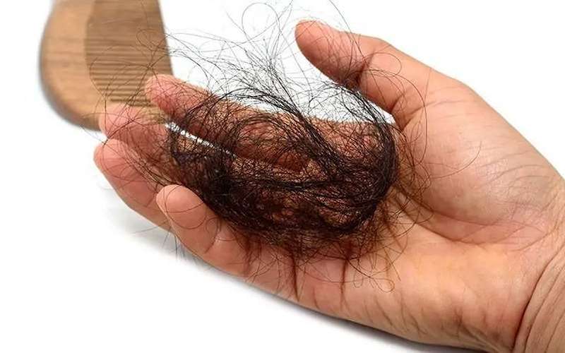 عوامل تاثیر گذار در ریزش مو