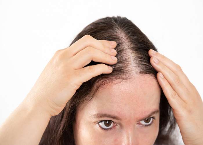 علل شایع ریزش موی هورمونی چیست؟