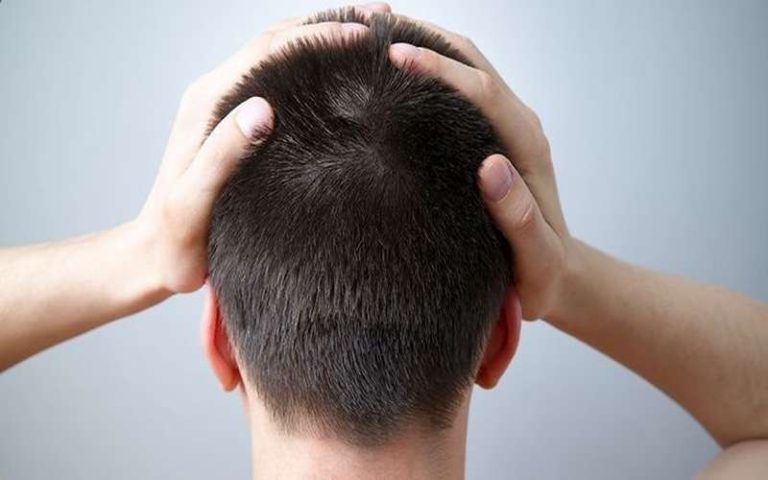 بعد از کاشت مو چطور بخوابیم؟