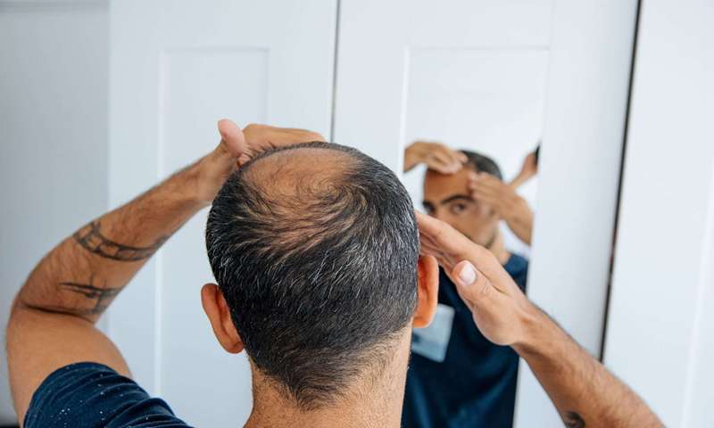 آیا ماینوکسیدیل باعث رشد مجدد مو می شود؟