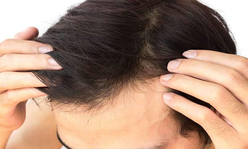 آیا ماینوکسیدیل باعث رشد مجدد مو می شود؟