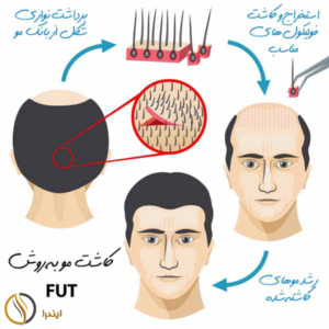 هزینه کاشت مو|عوامل موثر بر کاشت مو