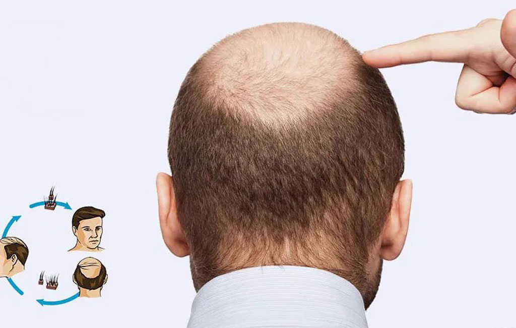 انواع پروتز مو از نظر مدت زمان